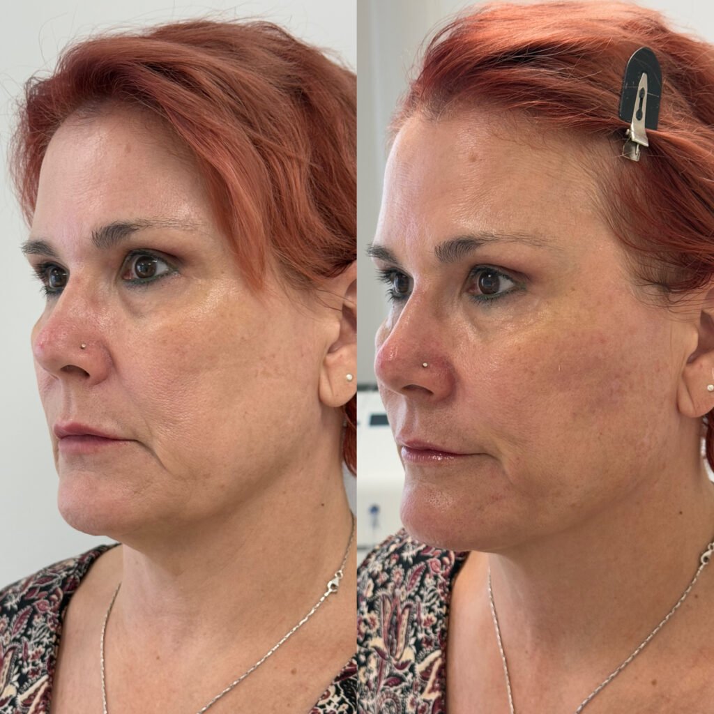 Antes y después lineas de marioneta tratadas con acido hialuronico mujer