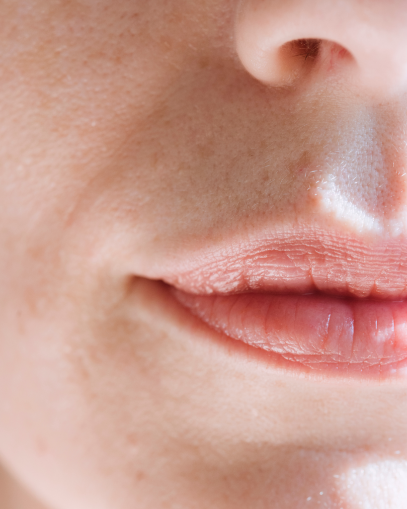 Aumento de labios