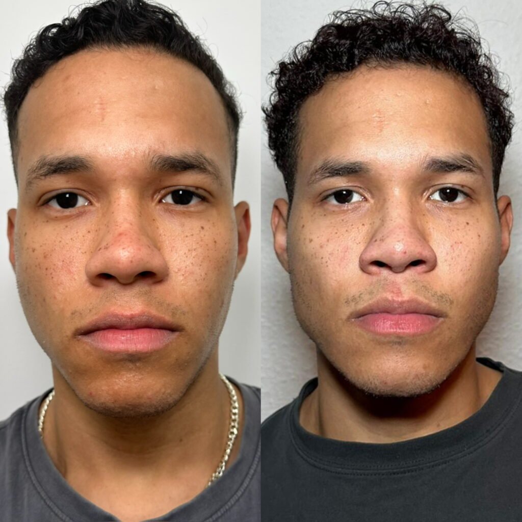 antes y despues armonizacion facial - contorno mandibular hombre en valencia