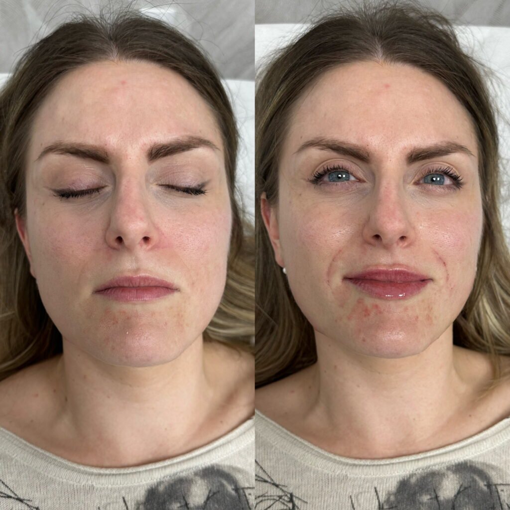 aumento de labios natural mujer con acido hialuronico en valencia