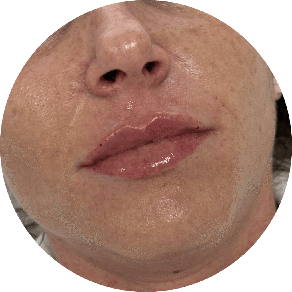 labios antes y después