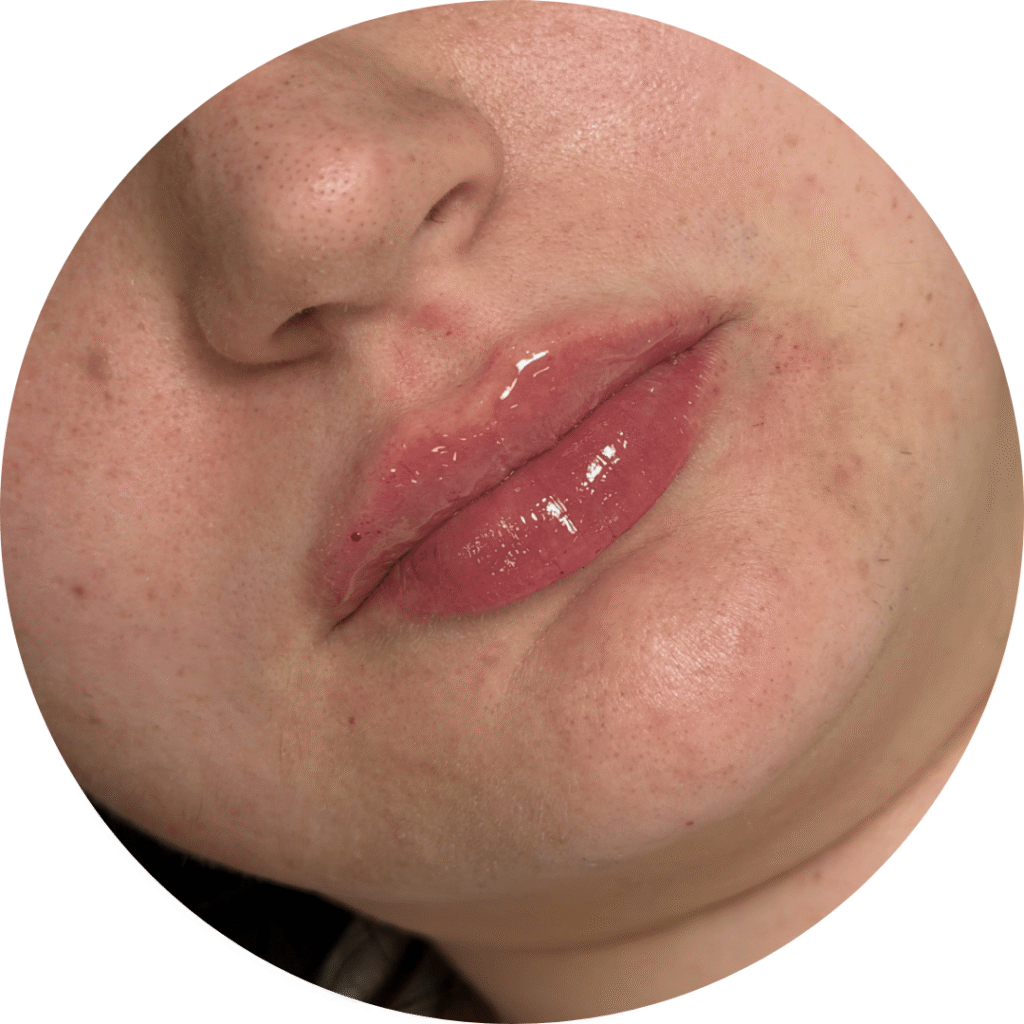 antes y después aumento de labios