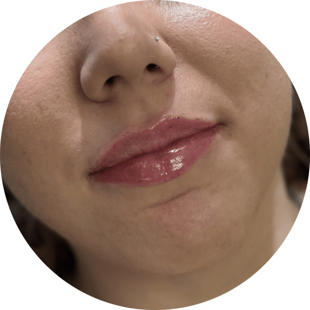 aumento labios antes y después