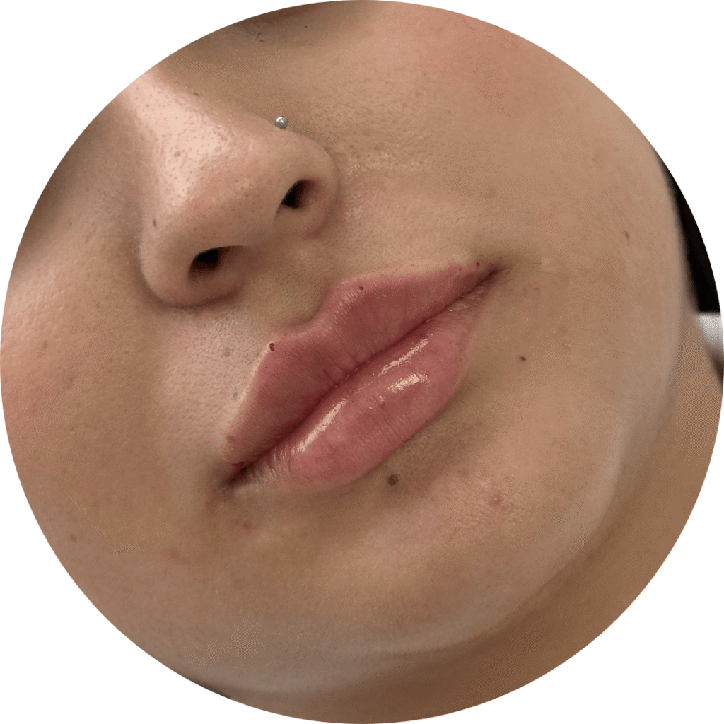 aumento de labios antes y después
