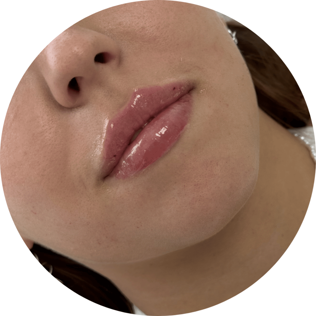 aumento labios antes y después