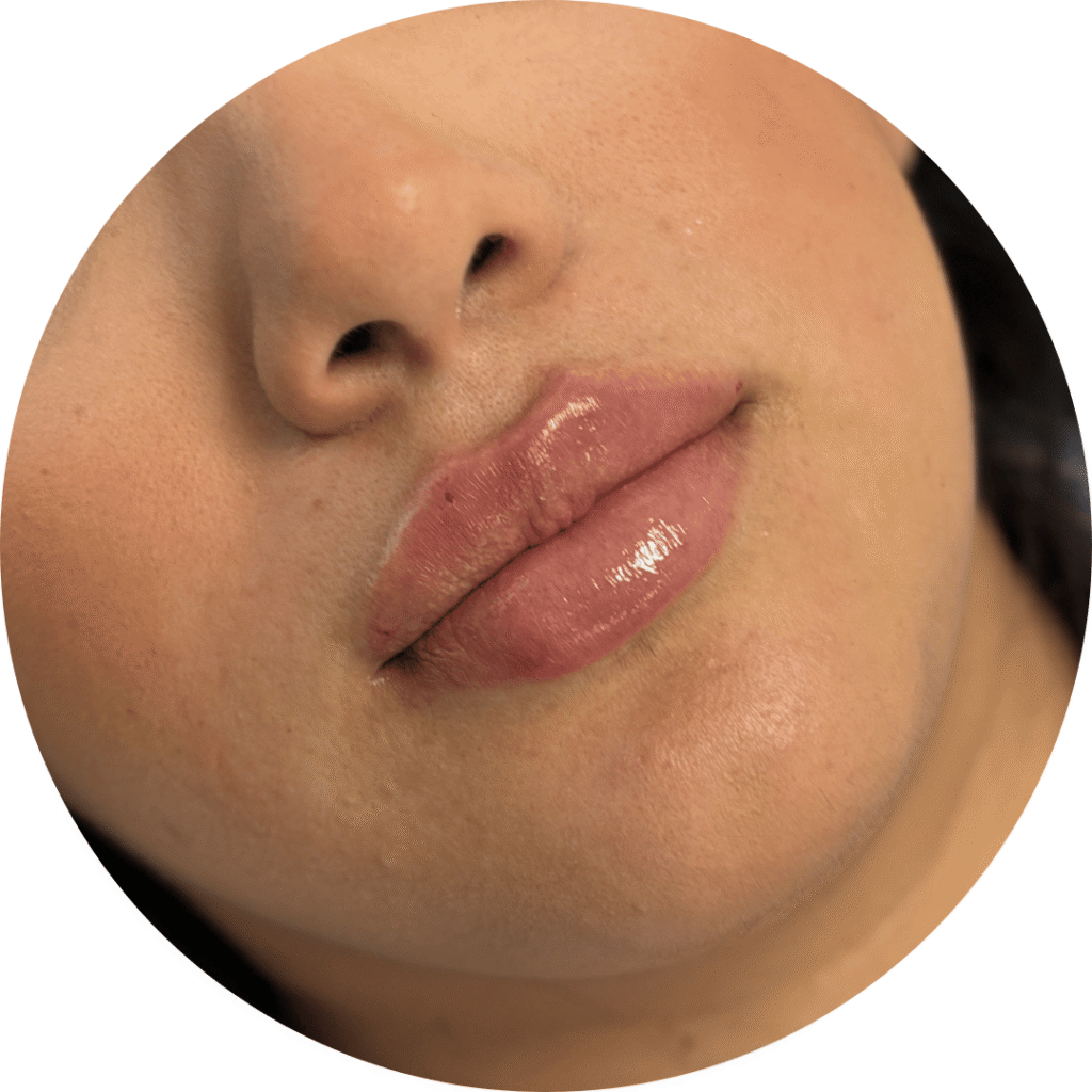 antes y después aumento de labios