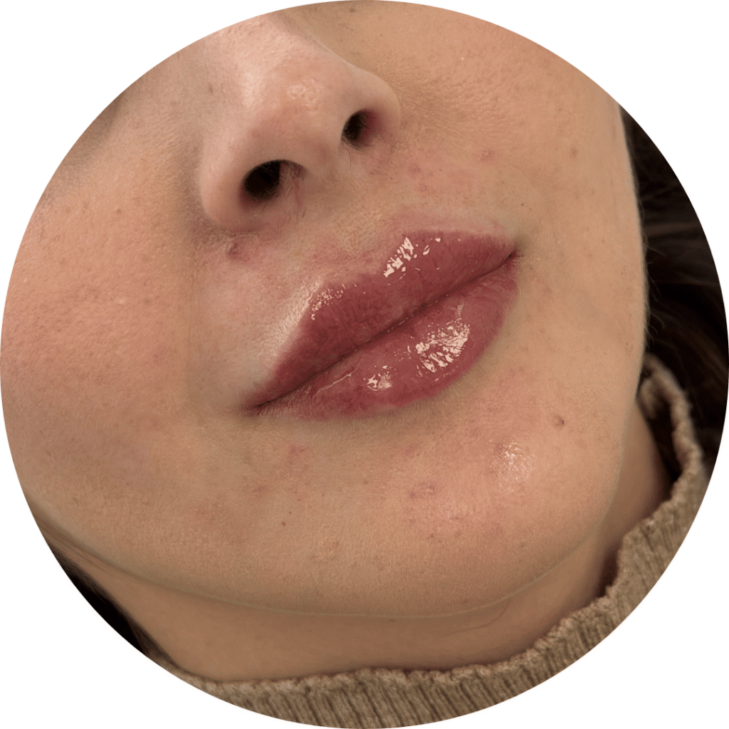 antes y después aumento de labios