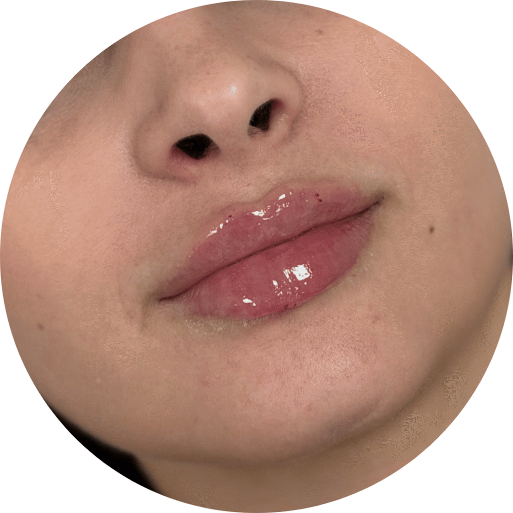 antes y después aumento de labios