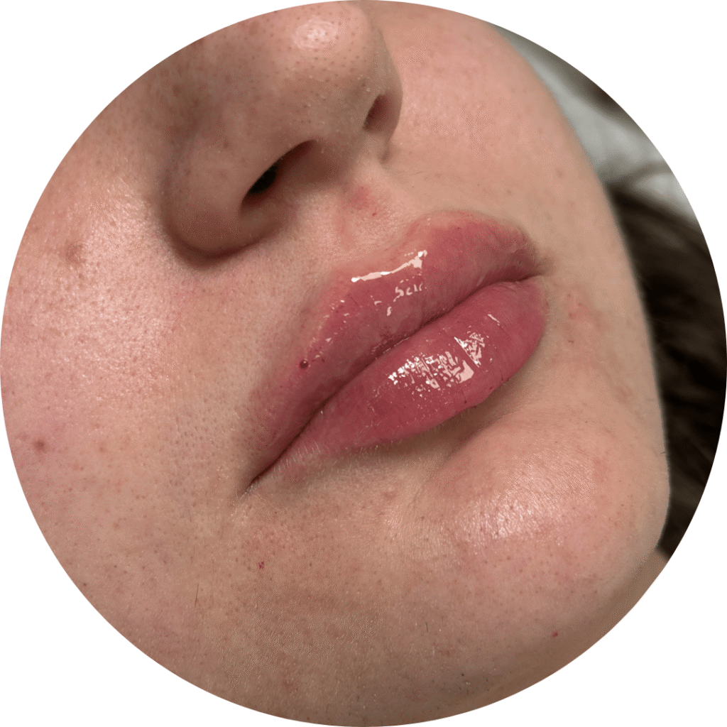 labios acido hialuronico antes y después