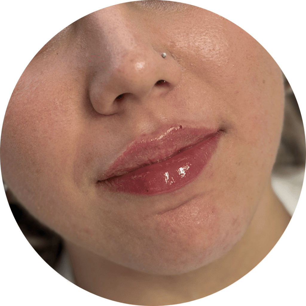 antes y después labios