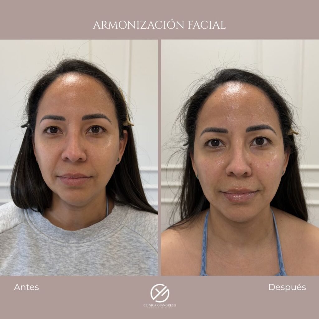 antes y despues armonizacion facial