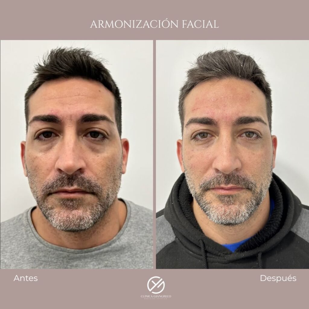 armonizacion facial antes y despues